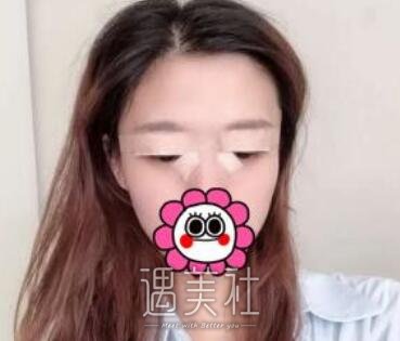 亓发芝,割双眼皮