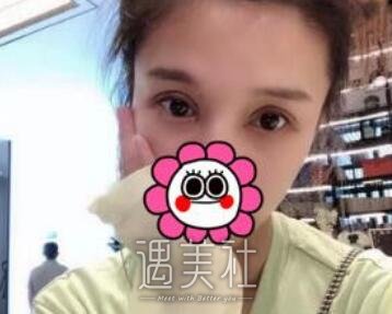 亓发芝,割双眼皮