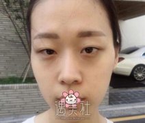 罗旭松双眼皮修复案例：做一个精致的猪猪女就是这么简单 width=