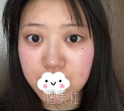罗旭松双眼皮案例：画上眼妆出门，回头率炒鸡高了 width=