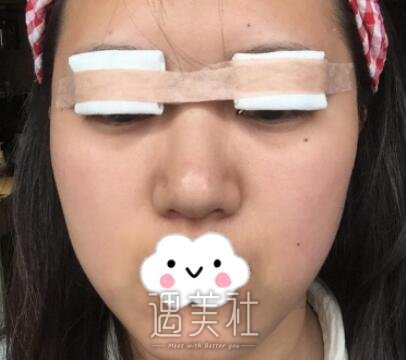 罗旭松,双眼皮