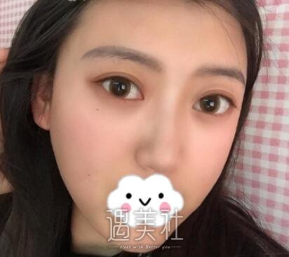 罗旭松,双眼皮