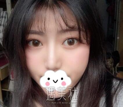 罗旭松,双眼皮