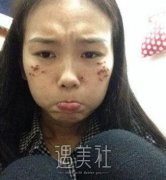 罗旭松去痣案例:感觉脸一下子变干净 width=