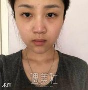 刘滢光子嫩肤案例：整个人看起年轻了好几岁 width=
