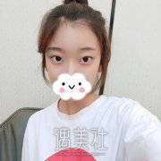 北京王世勇双眼皮修复怎么样?多少钱?有真实案例吗? width=