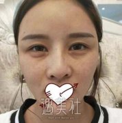 巫文云鼻子修复案例：看来隆鼻还得去正规的机构做啊~ width=