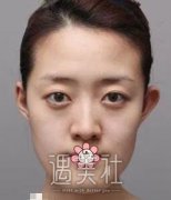 首尔丽格崔荣达地包天矫正案例：终于阔以笑着面对大家~ width=