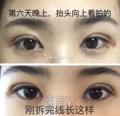扇形双眼皮