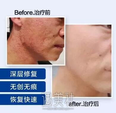 像素激光美容价格