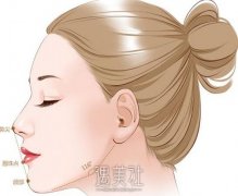 汕头垫鼻子大概多少钱?各个城市的收费标准应该不同吧? width=