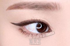荆州做自体脂肪填充下眼睑大概多少钱?怎么收费合理? width=