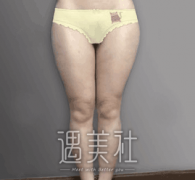 减肥案例做了大腿吸脂：锻炼节食啥都和我没关系~ width=