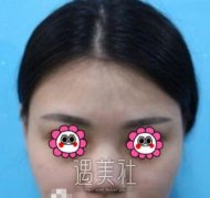 成都西区医院隆鼻案例：鼻子恢复果太自然了~ width=