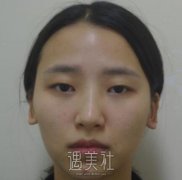 开了内眼角增生图片，真实恢复记录分享给大家～ width=