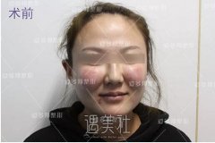 黎星院长苹果肌取出案例：拒绝成为非法行医的试验品~ width=