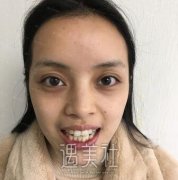 重庆当代医院隐形矫正怎么样?先来看看真实案例再说吧~ width=