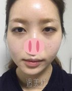 首尔丽格崔荣达高颧骨降低整形案例：看上去五官和谐多了 width=