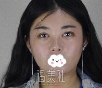 面部吸脂恢复期图片分享——来自真实面部吸脂案例一条~ width=