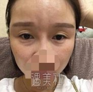 去健丽医美做了微创去眼袋，出门再不用害怕和别人对视了~ width=