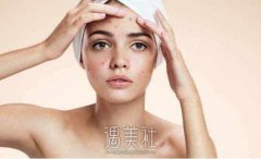 激光祛痘过程需要多久？激光祛痘后怎样护理利于恢复呢？ width=