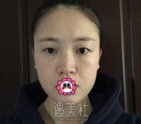 去美仑整形做了双眼皮手术，摇身一变成为大眼美铝哦~ width=