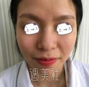 胶原蛋白隆鼻果好吗？这篇胶原蛋白隆鼻案例来告诉你~ width=