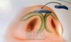 北京做隆鼻尖大概要多少钱?收费受哪些因素的影响喃? width=