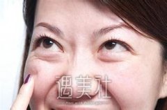 北京祛眼袋手术一般多少钱?方式不同收费也会不同吧? width=