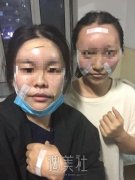 找斯勤医生给我做了面部填充，现在的是空前的自信啊~ width=