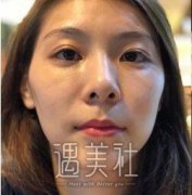 张笑天磨颧骨果怎么样？这里有篇他的磨颧骨案例哦~ width=