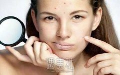 三甲医院做激光祛痘靠谱吗？激光祛痘是怎样的原理喃？ width=