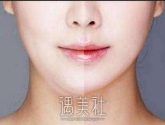 吸脂瘦脸手术是属于微整形吗？吸脂瘦脸手术要动刀吗？ width=
