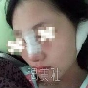 隆鼻尖多久恢复自然?不久前做过隆鼻尖的我有点话想说~ width=