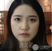做了鼻头肥大矫正和鼻尖成型，好多男同事来和我搭讪了~ width=