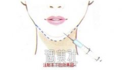杭州做玻尿酸垫下巴大约多少钱?下巴太短让我自卑啊~ width=