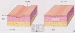 临沂做脂肪填充脸部要多少钱?是不是需要多次注射哦? width=