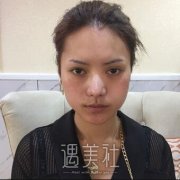 找黄志祥医生做了自体隆鼻，现在的我满脸洋溢着自信~ width=