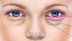 抚顺做手术调节眼袋需要多少费用，怎么个区间比较合理？ width=