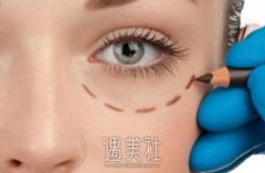 北京做埋线双眼皮手术大约多少钱喃？比其他方式收费贵吗？ width=