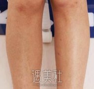 沧州美神整形医院做了脱毛？价格便宜但果还是很不错~ width=