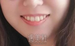 贵阳华美医院做了牙齿矫正，恢复情况比我想象中还更好~ width=