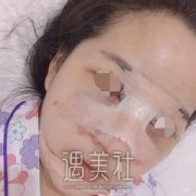 巫文云鼻子案例分享：巫文云不愧是鼻部整形界的大佬啊! width=