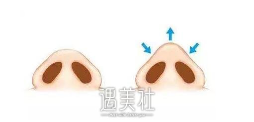 低鼻尖矫正术