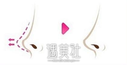 低鼻尖矫正术