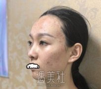 果酸换肤果怎么样？有没有果酸换肤真实案例展示一下喃？ width=