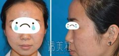 西京医院皮肤科做了激光祛痘，青春的我不待见“青春痘”~ width=