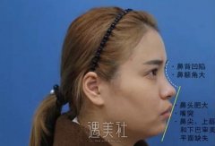 石家庄美联臣做了注射胶原蛋白隆鼻，现在的鼻型很八错～ width=