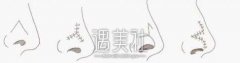 临沂市做鼻翼修复手术一般需要多少钱?当地的朋友说说～ width=