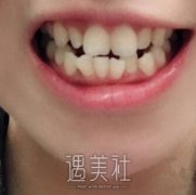 今年初去极光牙科做了牙齿矫正，理解了“笑出强大”为何意～ width=